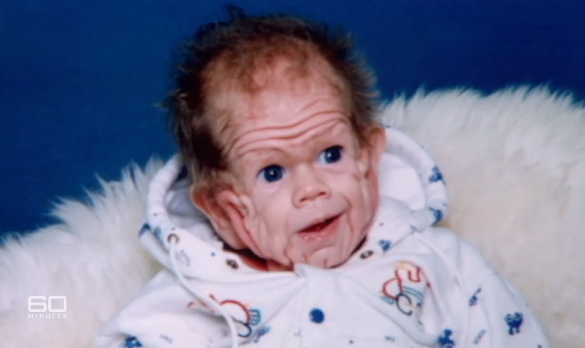 Baby Born With Enough Skin For A 5-Year-Old, Try Not To Shed A Tear When You See Him Now