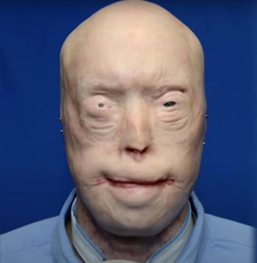 Firefighter Has Face Transplant After Third-Degree Burns And Survives Against All Odds – See Him Now, 7 Years Later