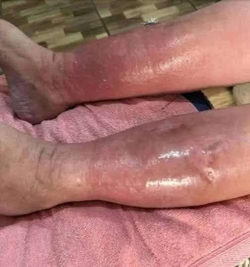 The Secret to Banishing Puffy Limbs: My Unconventional Journey to Edema-Free Living