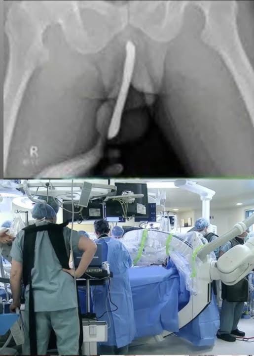 A young girl was hospitalized after attempting to use a male urination device