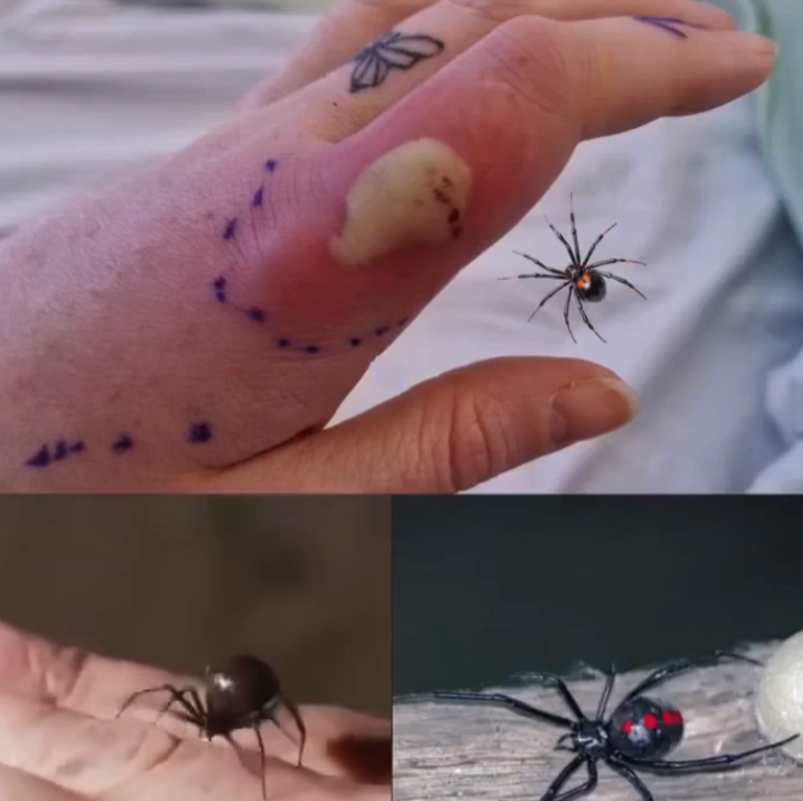 Black Widow Spider Bite: Essential Steps and Complete Care Guide