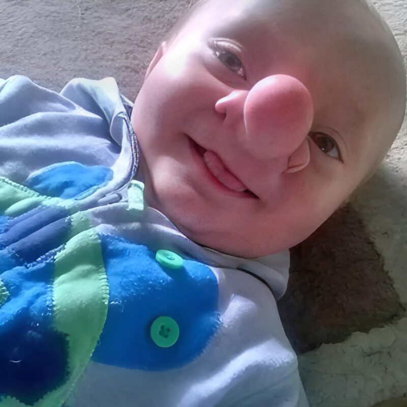 The little boy was born with a big nose, he was mocked and called Pinocchio, but he and his mother didn’t give up. See what he looks like today.