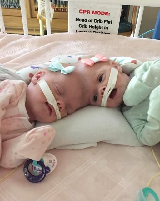 Conjoined twins Abby and Erin Delaney: Inside their remarkable story