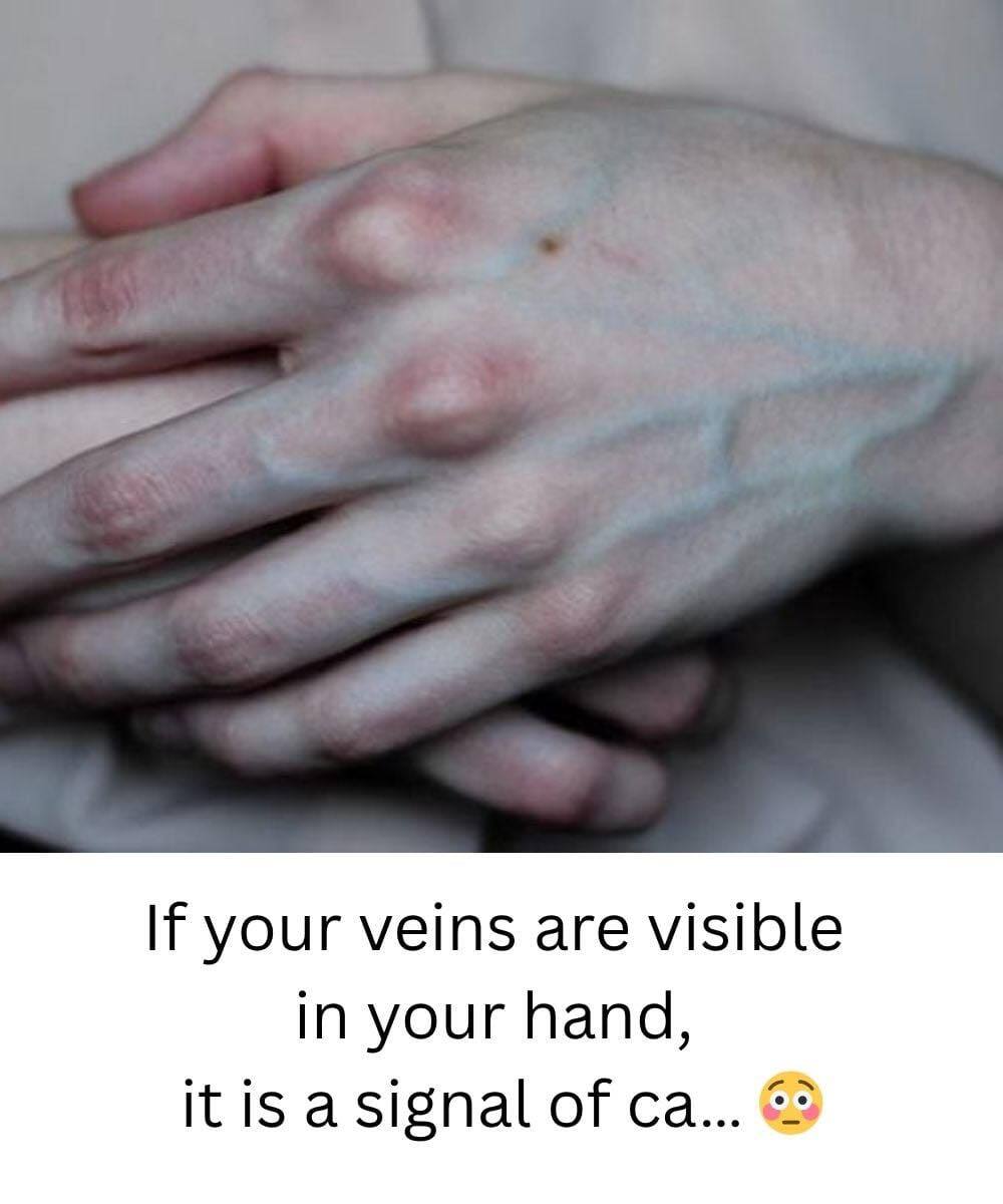 What the Veins on Your Hands Might Reveal About Your Liver Health
