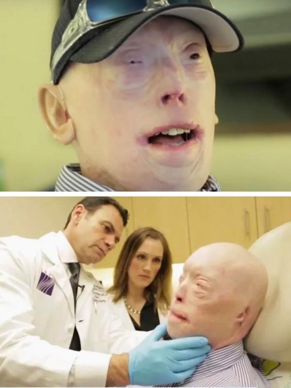 Patrick Hardison Received A New Face After Third-degree Burns