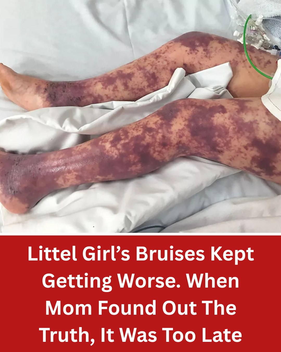 Little Girl’s Bruises Kept Getting Worse. When Mom Found Out The Truth, It Was Too Late…