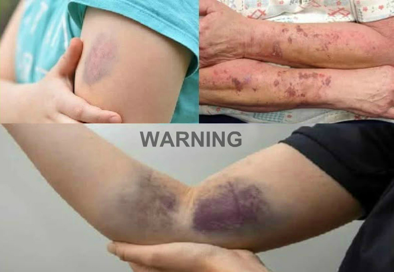 BE CAREFUL, if you get these bruises on your body, it means you have…