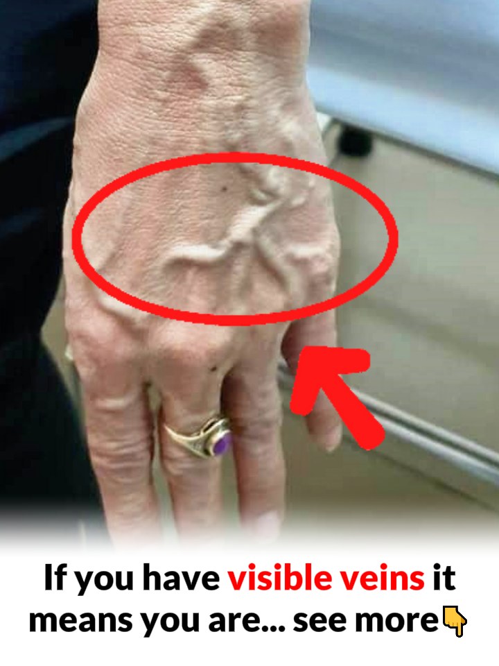 When to Worry About Veins That Appear Out of Nowhere