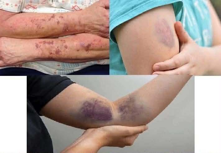 BE CAREFUL, if you get these bruises on your body, it means you have Ca…see more