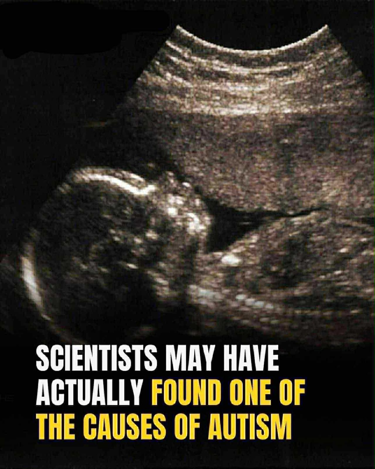 Study identifies possible connection to autism development