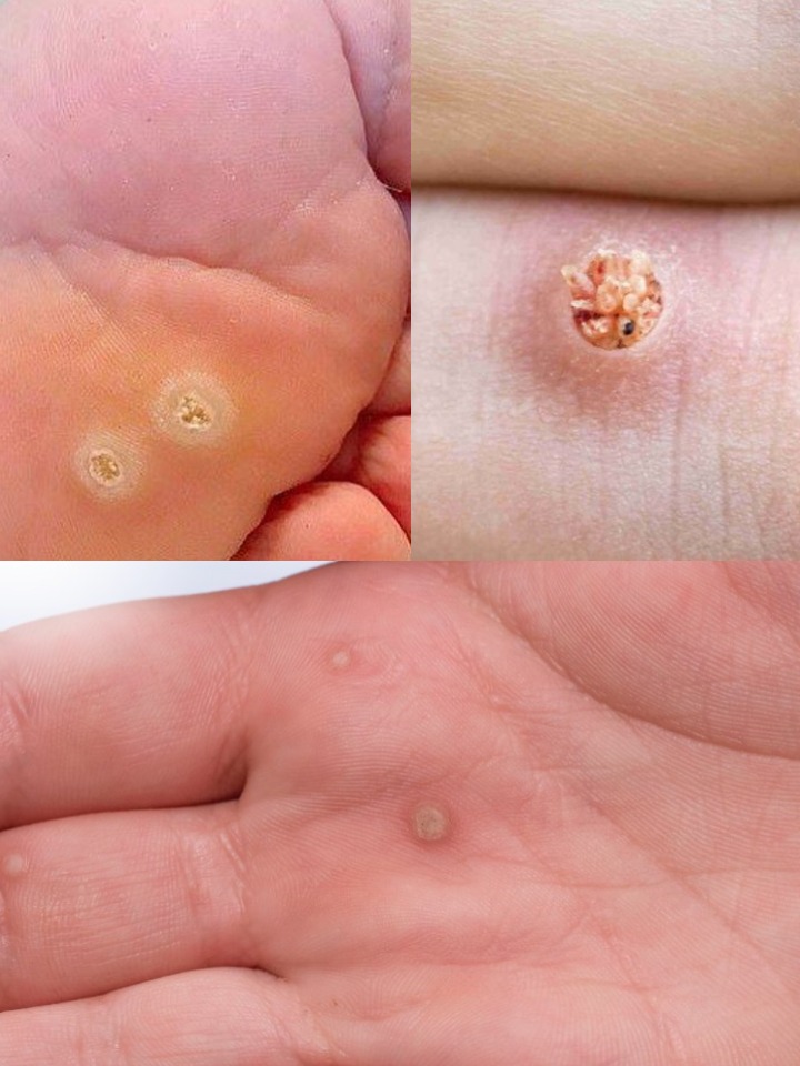 Be Very Careful: If You Notice This Skin Growth, It Could Be Serious