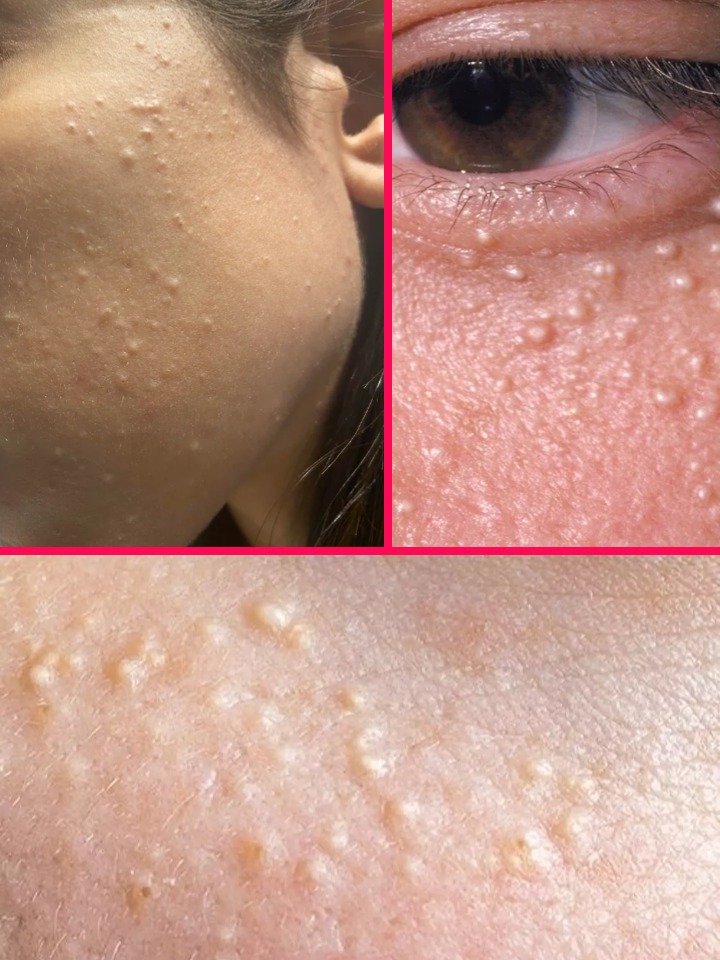 White Bumps on the Skin: Causes, Natural Solution, and Practical Tips