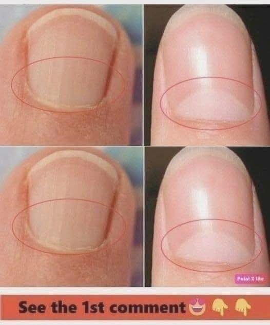 If You Don’t Have A Half Moon Shape On Your Nails, Visit A DOCTOR Immediately…