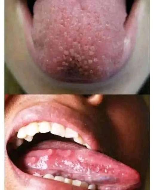 If you have pimples on your tongue, your body is warning you about something very important see