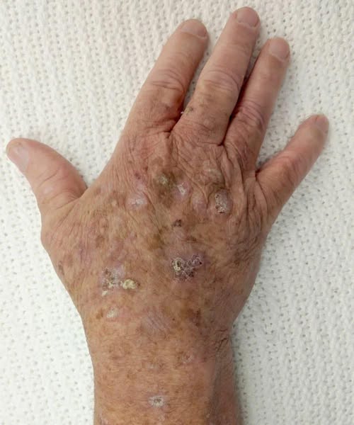 ATTENTION to These First Signs of Actinic Keratosis — The Subtle Skin Changes That Can Signal the Earliest Stage of Skin Cancer and Why Noticing Them in Time Could Save Your Life, Especially If You Have Years of Sun Exposure or Aging Skin